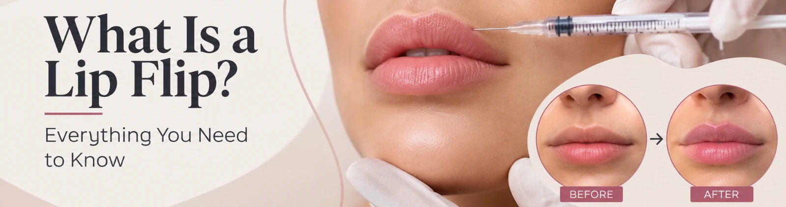 Aesthetics Wise - What is a Lip Flip